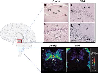 Medullary Serotonergic Binding Deficits and Hippocampal Abnormalities in Sudden Infant Death Syndrome: One or Two Entities?